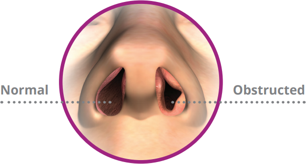 nasal-obstruction-treatment-with-vivaer-ryan-stern-md-in-federal-way